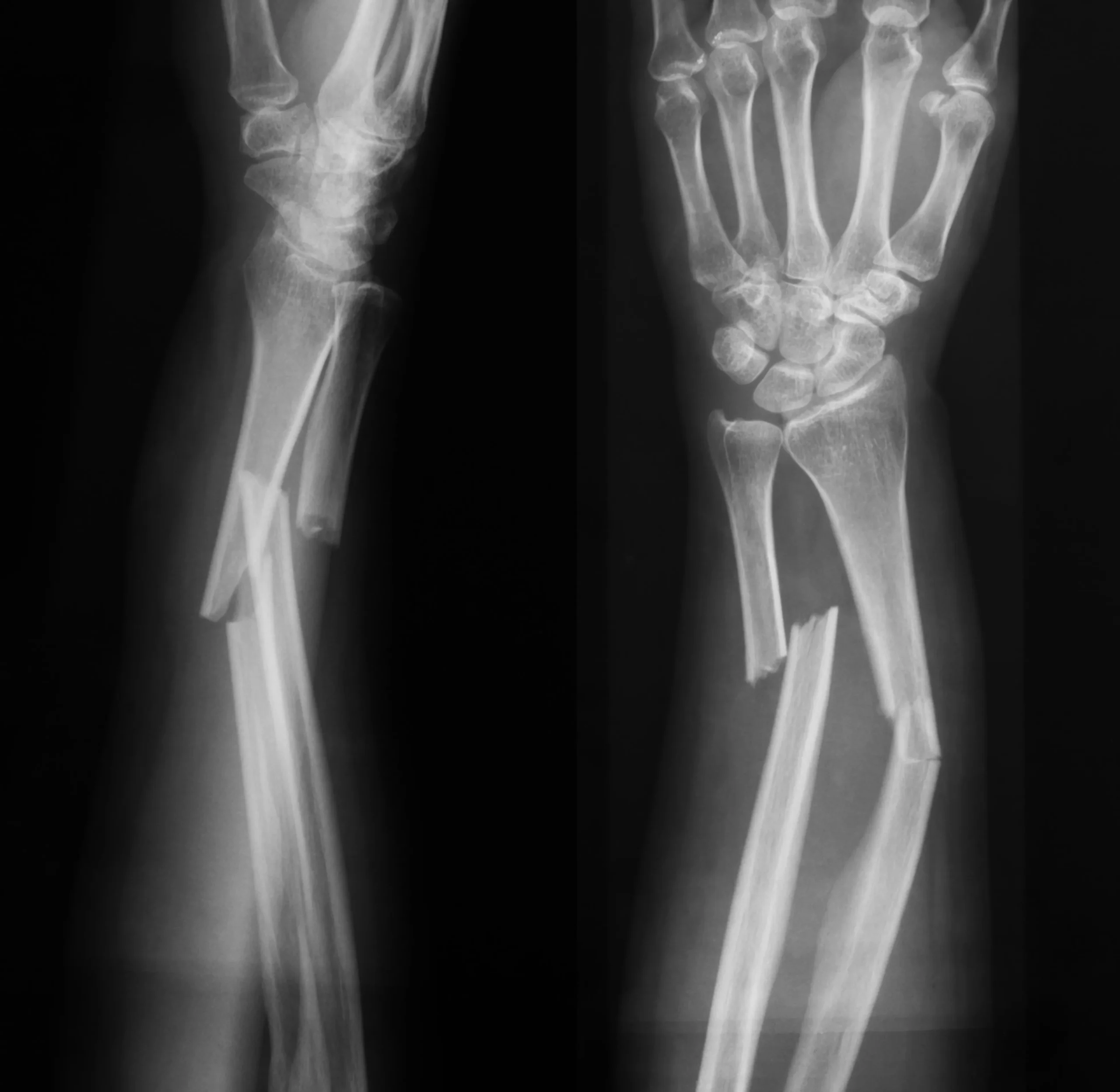An x-ray view of a broken bone.